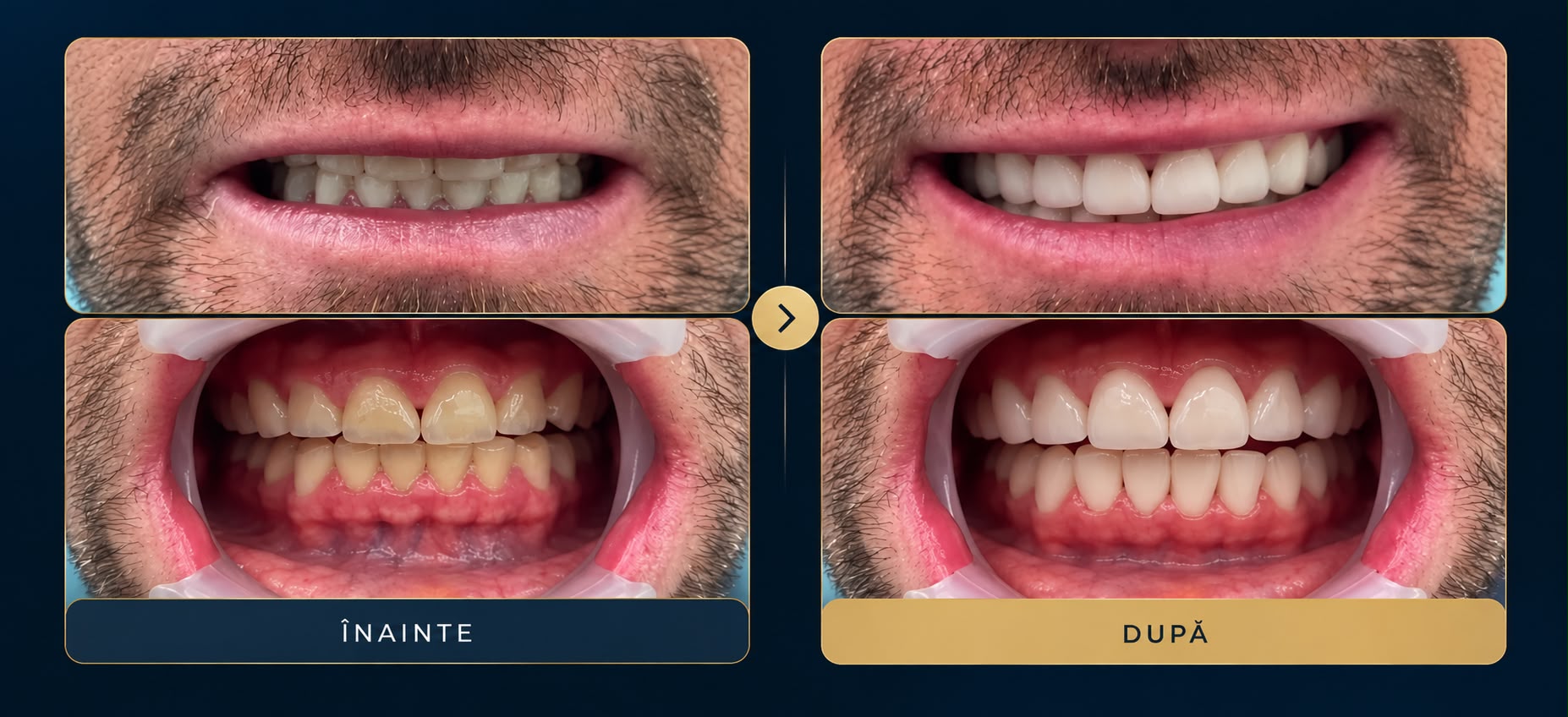 Înainte și după: Reabilitare orală totală după bruxism