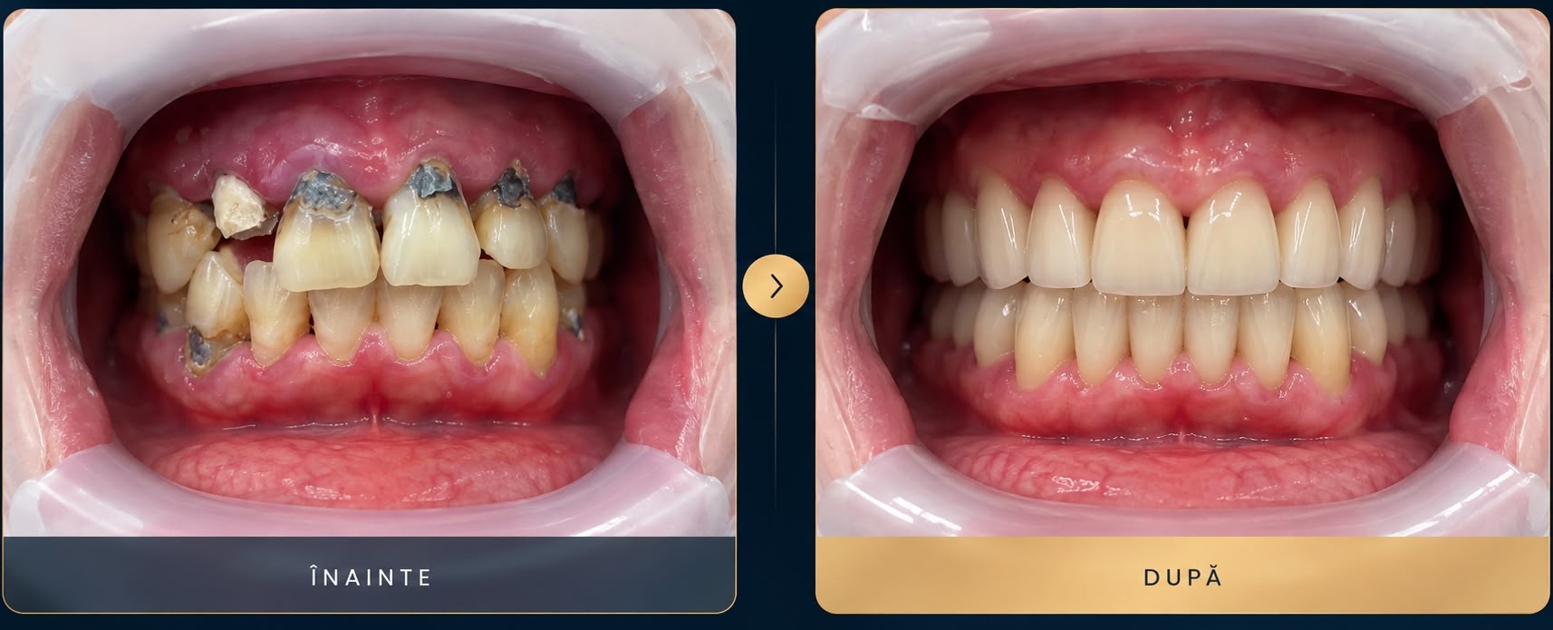 Caz clinic: reabilitare orală totală cu coroane și punți, înainte și după