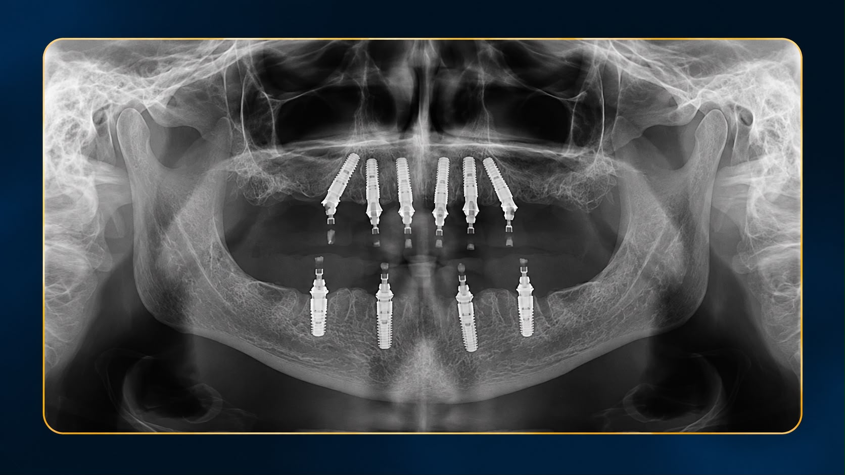 Radiografie panoramică cu implanturi dentare